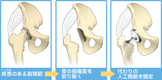 股関節置換術（THA）