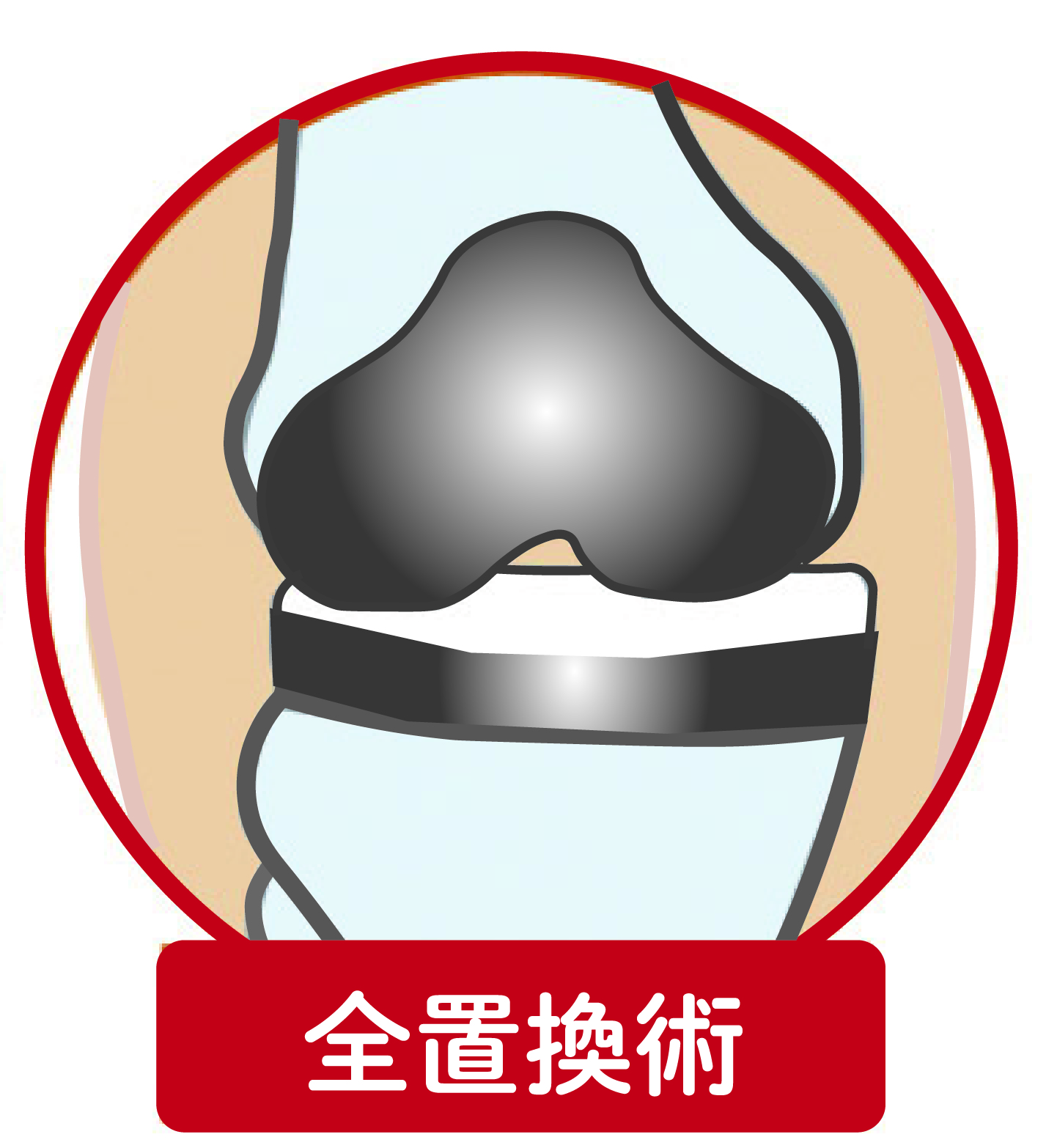 膝の全置換術イメージ