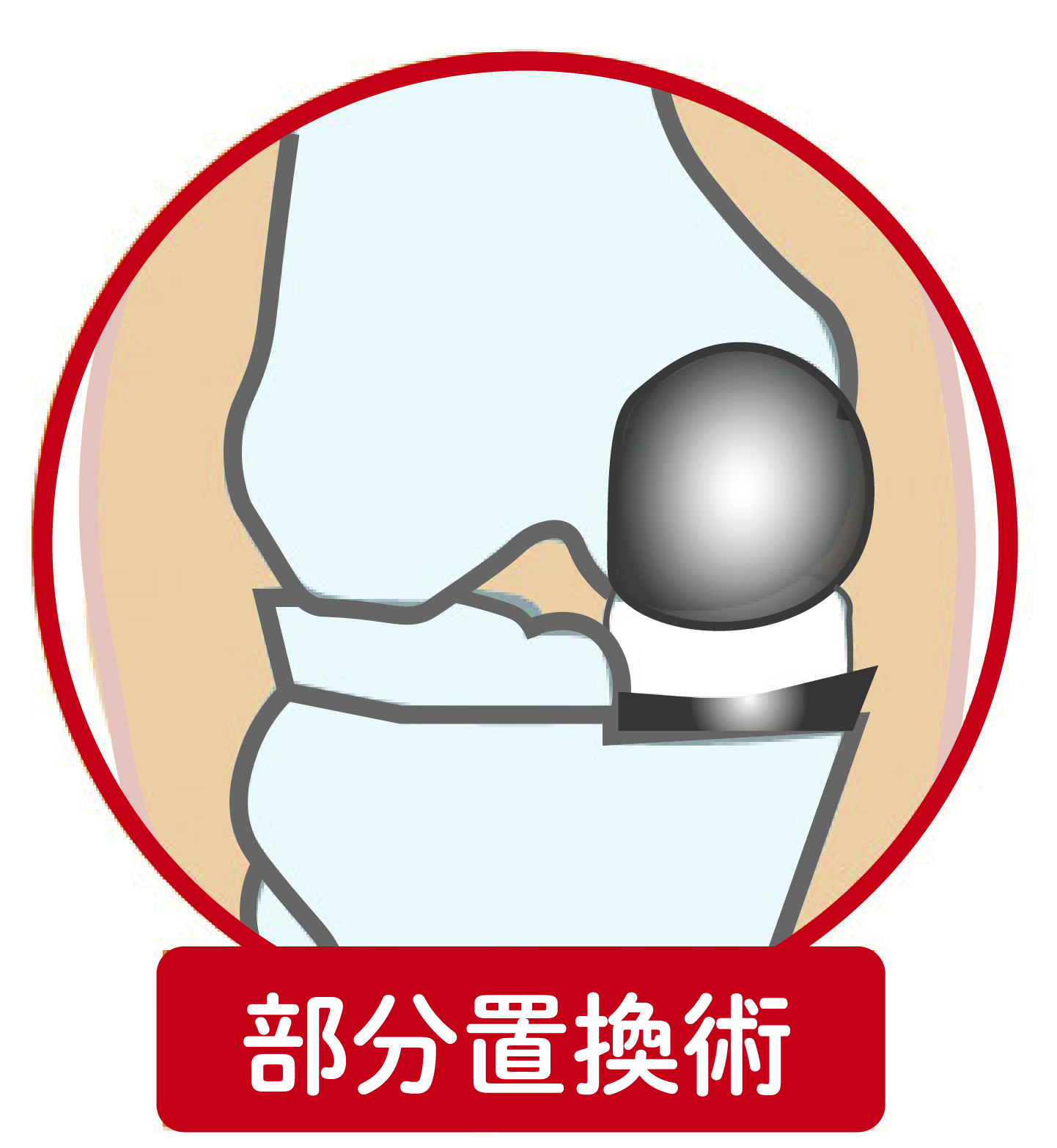 膝の部分置換術イメージ